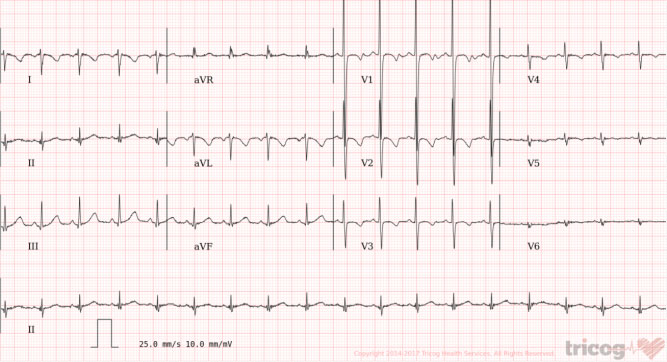 Wolff Parkinson White Syndrome: A rare heart syndrome diagnosed by ...