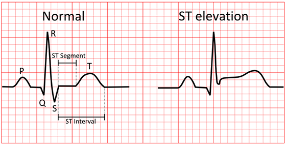 Stemi Grid | Tricog